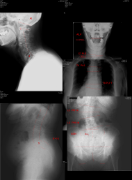脊柱管狭窄症　変形性膝関節症