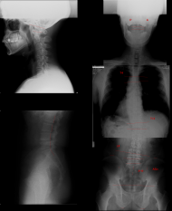 椎間板ヘルニア　脊柱管狭窄症